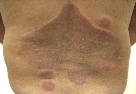 Eosinophilic Cellulitis Wells Syndrome Successfully Treated With