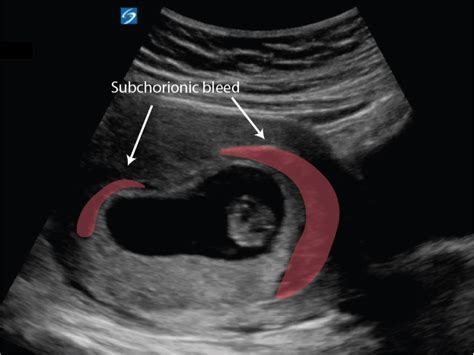 Subchorionic Bleed10 Week Pregnancy Critical Care Sonography