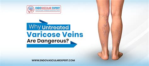 Why Untreated Varicose Veins Are Dangerous Dr Nikhil Bansal
