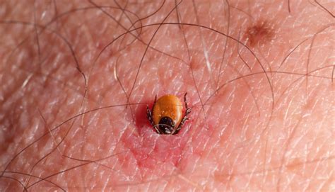 Tick Embedded In Skin Identifyus