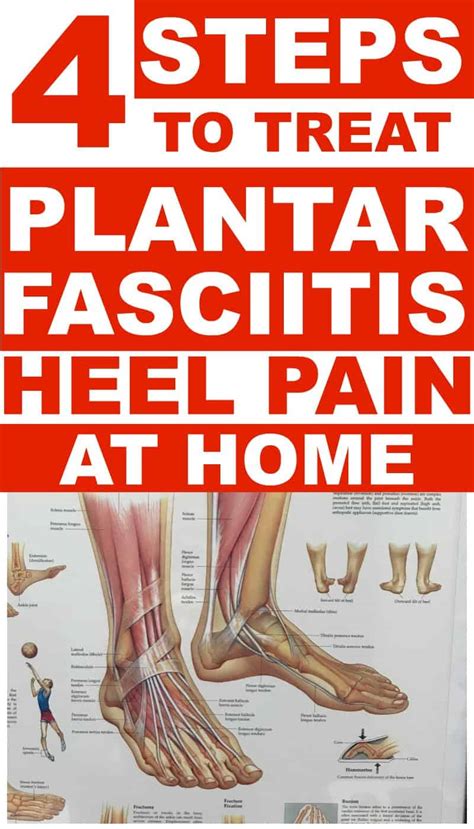 3cb Performance How To Treat Plantar Fasciitis A
