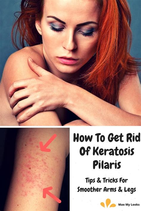 How To Get Rid Of Keratosis Pilaris Keratosis Pilaris Serious Skin