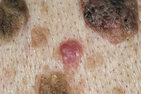 Skin Cancer That Looks Like A Wart