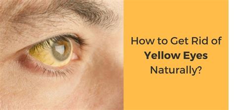 How To Get Rid Of Yellow Eyes Teethwalls