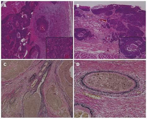 An Extremely Rare Case Of Pancreatic Metastasis Of Esophageal Squamous