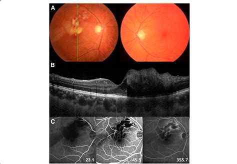 A The Right Fundus Showing An Ischemic Change At The Posterior Pole