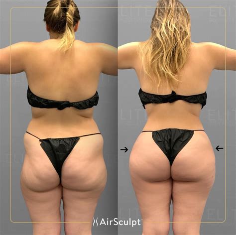 Hip Dip Before And After