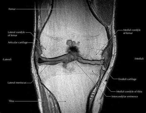 What Is Osteoarthritis And Why Is It So Hard To Diagnose