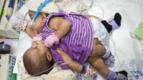 Conjoined Twins Separated After 26 Hour Long Surgery • Utah Peoples Post