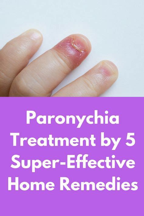 Paronychia Treatment By 5 Super Effective Home Remedies Paronychia Is A