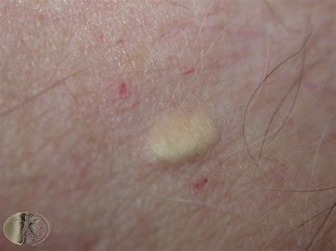 Sebaceous Cyst Armpit