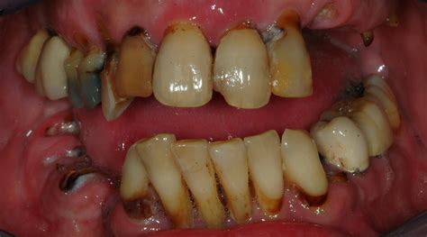 Gum Disease Solutions Long Island Koeppel Dental Group