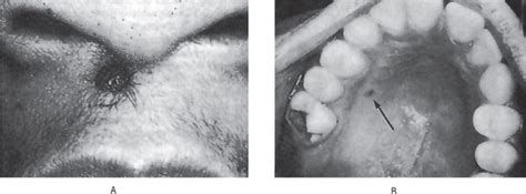 2 Benign And Malignant Tumors Of The Oral Cavity Pocket Dentistry