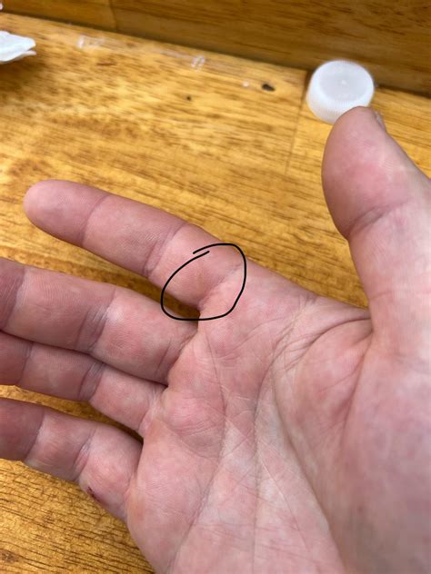 Do you have this callus? : r/KitchenConfidential