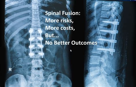 Spinal Fusions Necessary Treatment Regenerative Orthopedic Institute