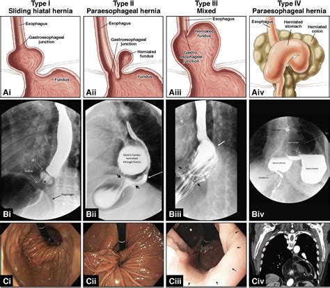 Hiatal And Paraesophageal Hernias Clinical Gastroenterology And