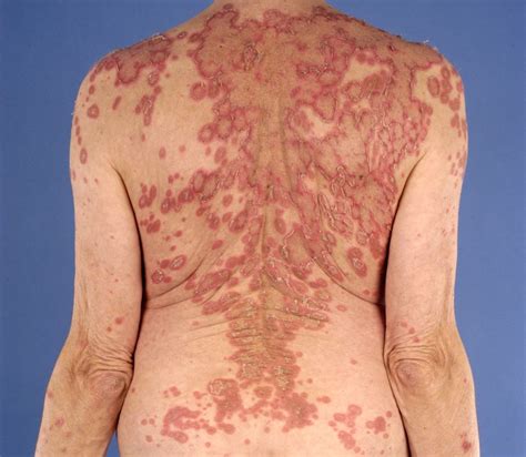 Lupus, mayo clinic, lupus detailed fact sheet, centers for disease control and prevention, lupus, american college of rheumatology. Subacute cutane lupus erythematosus (SCLE)