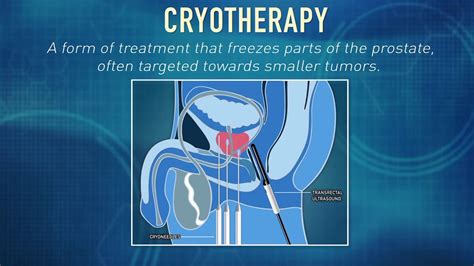 What Is Cryotherapy Global Robotics Institute Adventhealth Youtube