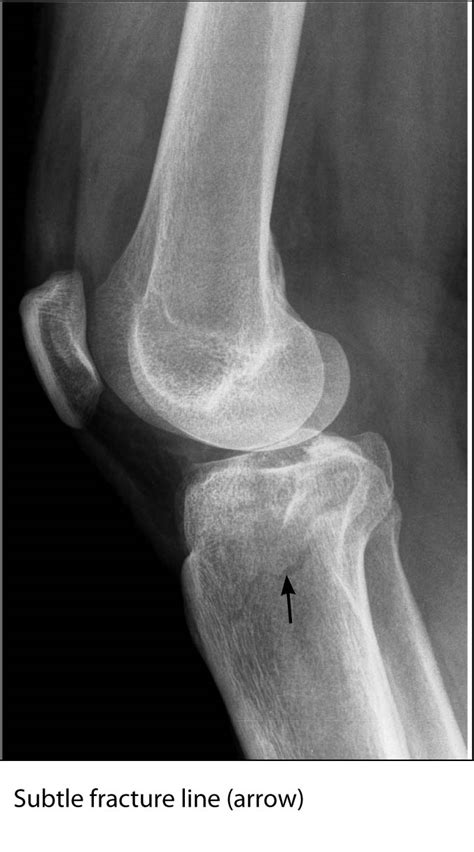 Icd 10 Code For Medial Tibial Plateau Fracture