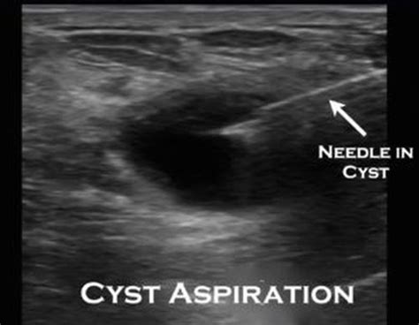 Cyst Aspiration Capitol Imaging Services