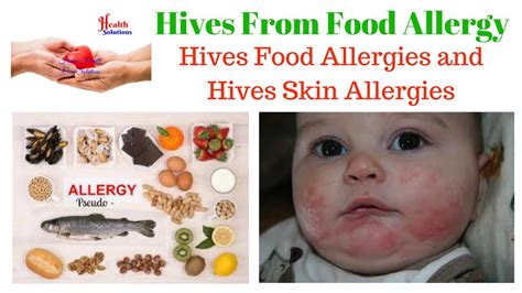 Hives From Food Allergy Hives Food Allergies And Hives Skin Allergies
