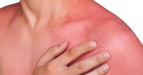 What Does A Heat Rash Look Like Pictures Natural Ways To Get Rid Of