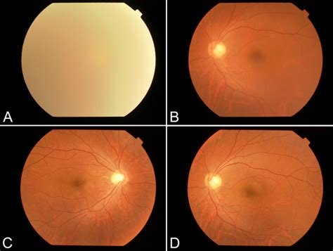 Fundus Photograph Before And After The Surgery A Fundus Photograph