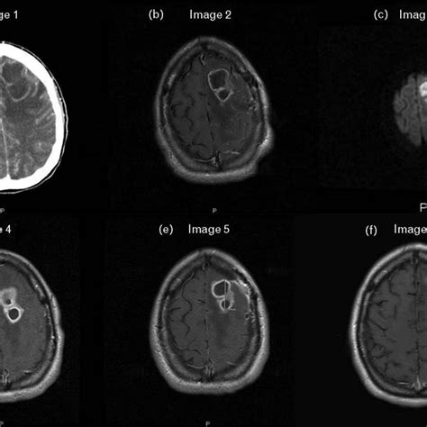 Mri Series Of The Pyogenic Brain Abscess In Toxoplasmosis Lesion In A