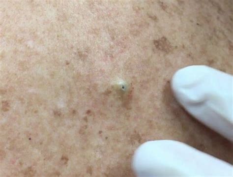 Watch Dr Pimple Popper Cyst Removal After 10 Years