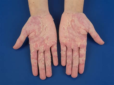 Blauwe plekken worden ook wel hematomen of bloeduitstortingen genoemd en kunnen zelfs ontstaan op spierweefsel of op de botten. Erysipelas (wondroos, belroos) (patientenfolder)