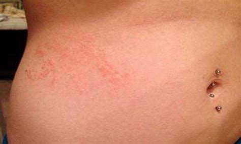 How To Identify Scabies Rash Its Management Dr Sudhee Vrogue Co