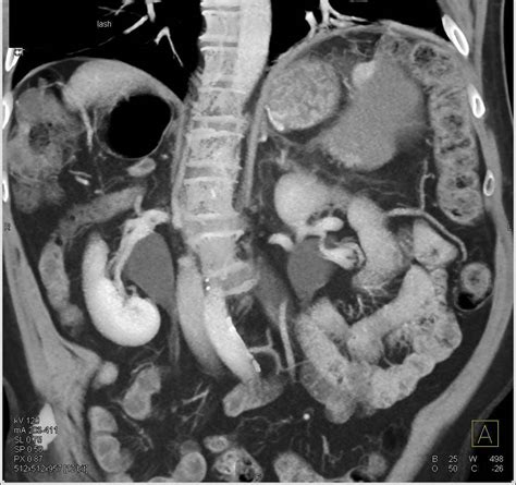 Large Splenic Infarct Spleen Case Studies Ctisus Ct Scanning