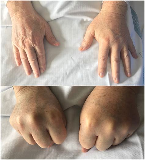 Bilateral Hand Edema Simply Nothing Or Nothing Simple European