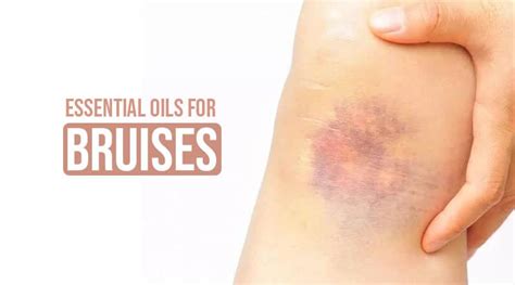 Top 6 Essential Oils For Bruises Healthtostyle