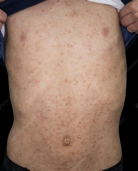 Atopic Dermatitis Stock Image C0180322 Science Photo Library