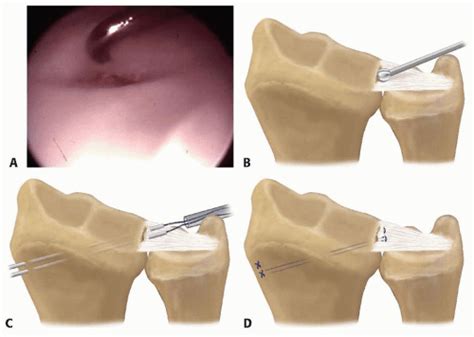 Arthroscopic And Open Triangular Fibrocartilage Complex Repair