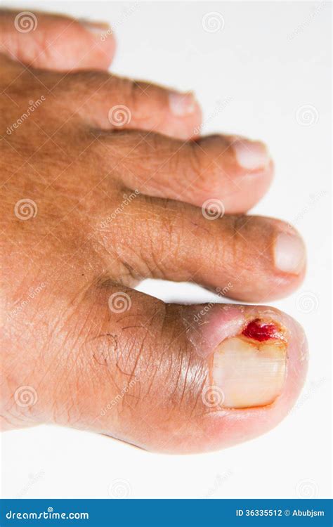 Ingrown Toenails On A Woman`s Foot Isolated On White Background Pain