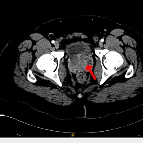 Ct Of The Abdomenpelvis With Contrast Demonstrating A Moderately