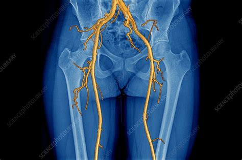 Arteries Of The Lower Limbs 3d Ct Scan Stock Image C0030996