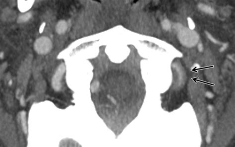 Imaging And Management Of Blunt Cerebrovascular Injury Radiographics