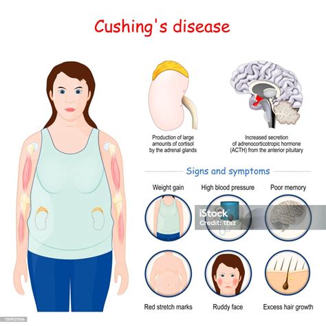 cushings disease signs and symptoms of cushing syndrome stock illustration download image now