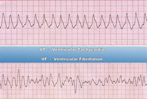 Ventricular Tachycardia Overview Causes Symptoms Treatment