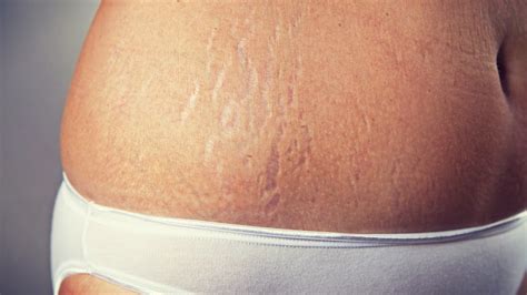 Home Treatment To Prevent Stretch Marks Life Health Max