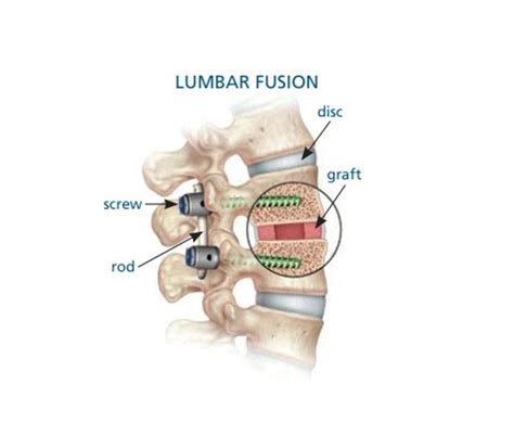Posterior Lumbar Fusion Surgery Depuy Synthes