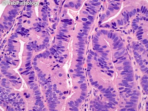 Webpathology Com A Collection Of Surgical Pathology Images