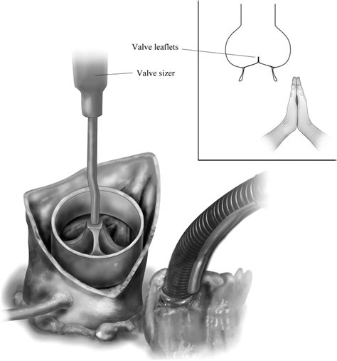 Valve Sparing Aortic Root Replacement In Children Operative