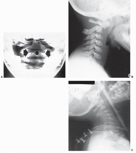 Treatment Of Cervical Spine Instability In The Pediatric Patient