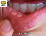 Images of Home Remedies Infected Cut