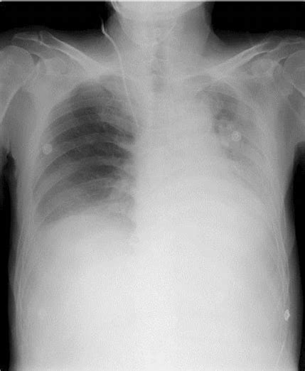 Chest X Ray On Pod 7 Shows Massive Atelectasis In The Left Lower Lobe