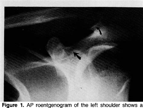 Figure 1 From Combined Acromioclavicular Dislocation With